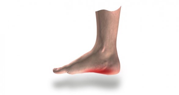 Illustration of foot with red area indicating pain caused by Plantar Fasciitis